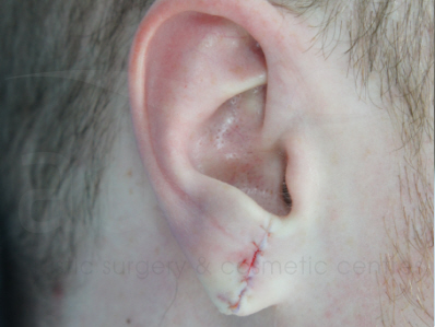 After-Earlobe