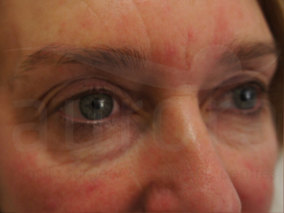 Before-Eyelid Surgery