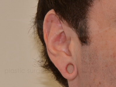 Before-earlobe