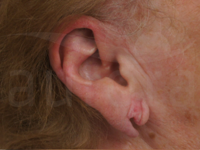 Before-Earlobe surgery