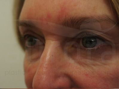 Before-Eyelid Surgery