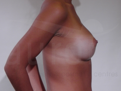 After-Breast Enlargement