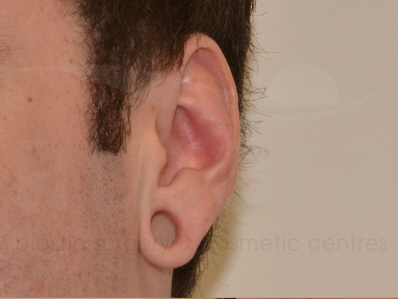 Before-Earlobe