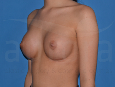 After-Breast Enlargement