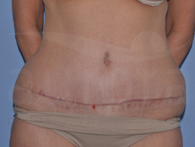 After-Liposuction