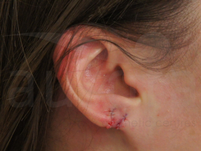 After-Split Earlobe repair