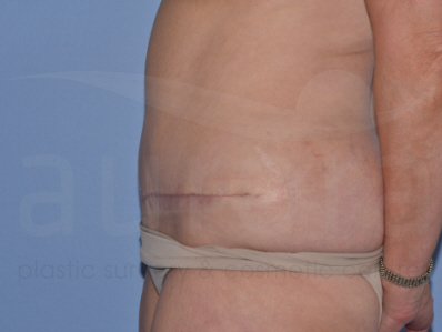 After-Liposuction