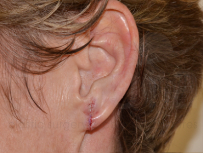 After-Split Earlobe