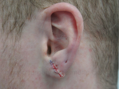 After-Earlobe