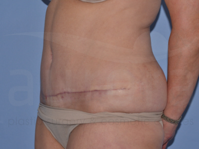 After-Liposuction