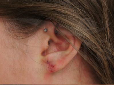 After-Split earlobe repair