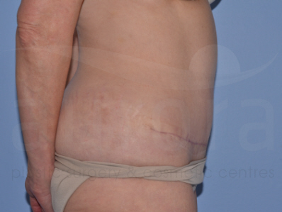 After-Liposuction
