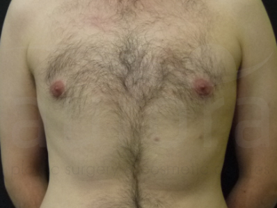 After-Gynecomastia