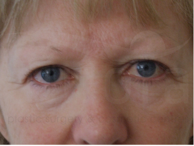 Before-Eyelid surgery