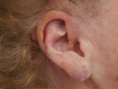 After-Earlobe surgery