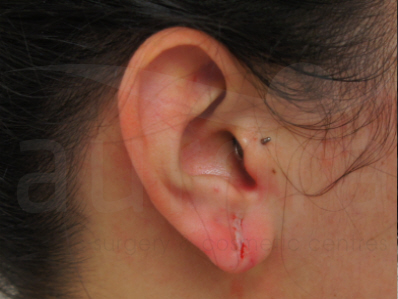 After-Earlobe repair