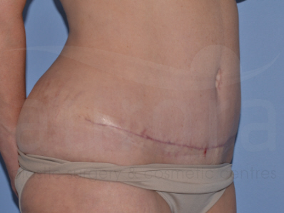 After-Liposuction