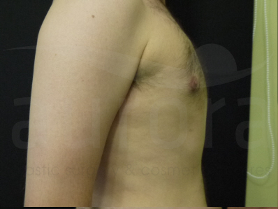 After-Gynecomastia