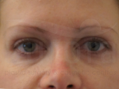 Before-Eyelid surgery