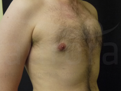 After-gynecomastia