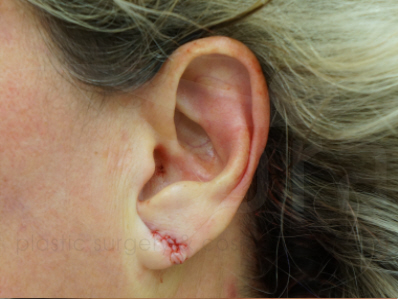 After-Split Earlobe