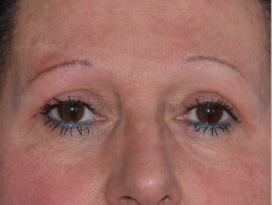 After-Eyelid surgery