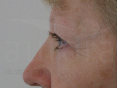 Before-Eyelid surgery