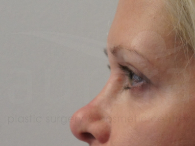 Before-Eyelid surgery