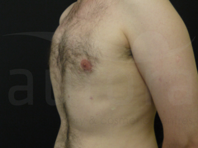 After-Gynecomastia