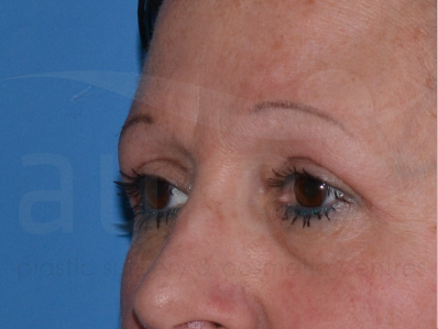 After-Eyelid surgery