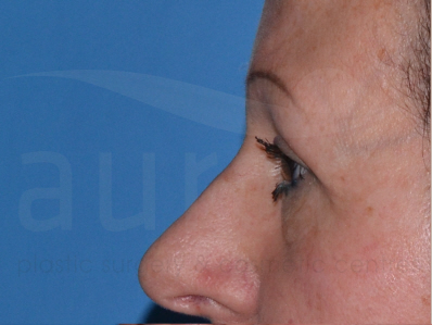 After-Eyelid surgery