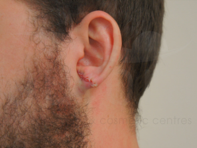 After-Earlobe