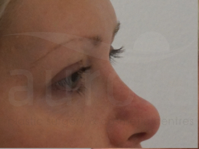 Before-Eyelid surgery