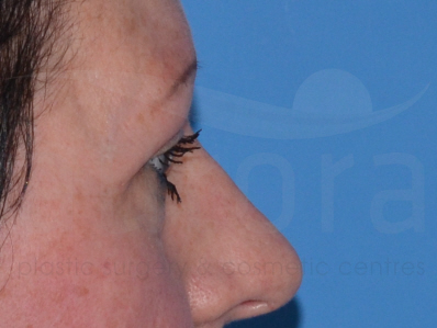 After-Eyelid surgery