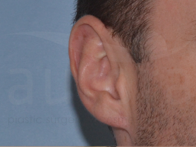 After-earlobe