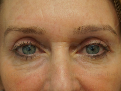 After-Eyelid Surgery