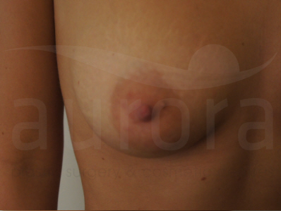 Before-Areola Reduction