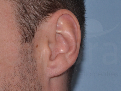 After-Earlobe