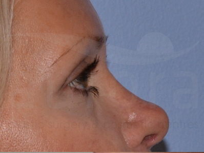 After-Eyelid surgery