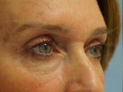 After-Eyelid Surgery