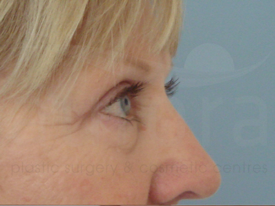 After-Eyelid surgery