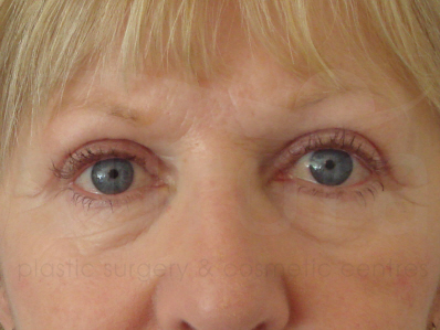 After-Eyelid surgery