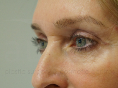 After-Eyelid Surgery