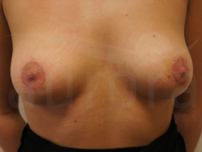 After-Areola Reduction