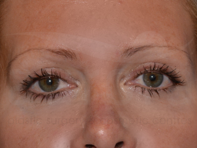 After-Eyelid surgery