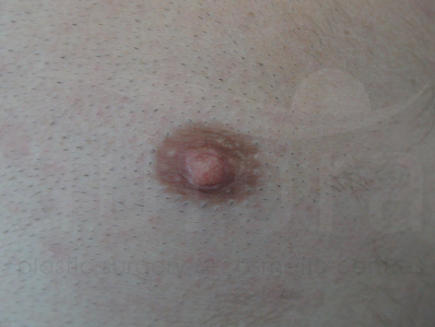 After-Nipple reduction