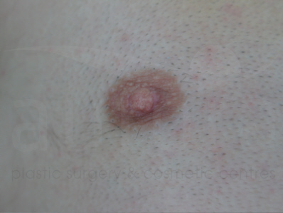 After-Nipple reduction