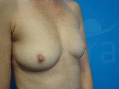 Before-Breast Enlargement