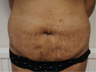 Before-Tummy Tuck