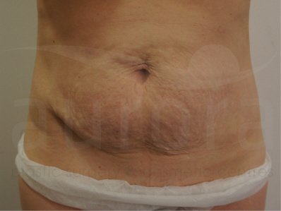 Before-Tummy Tuck